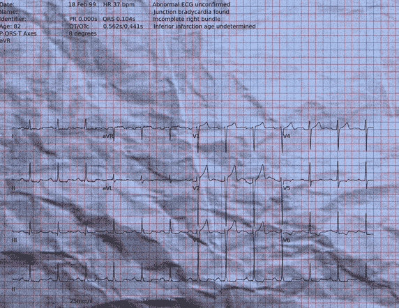Normal ECG — PTB-XL