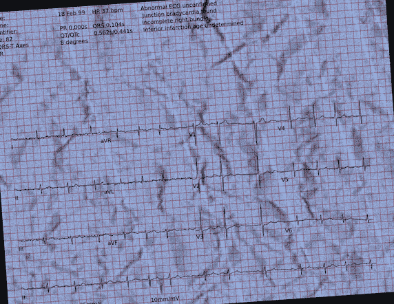Normal ECG — PTB-XL