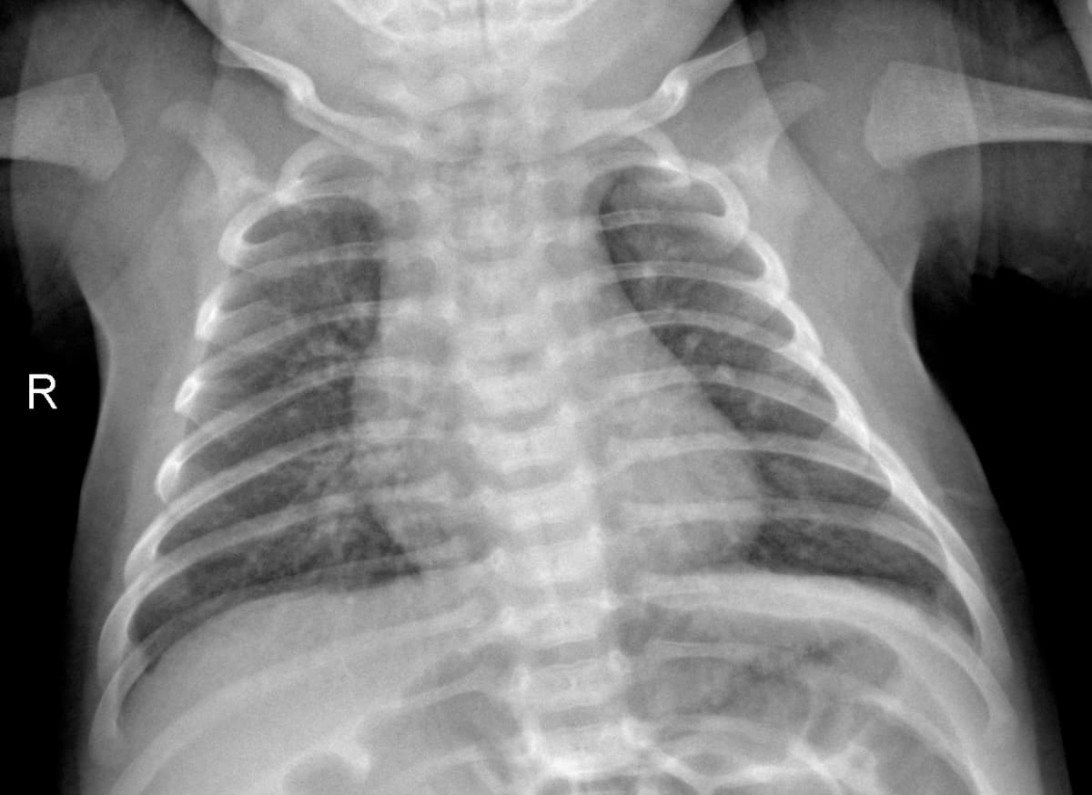 Radiografia Normal — NIH Chest X-ray14