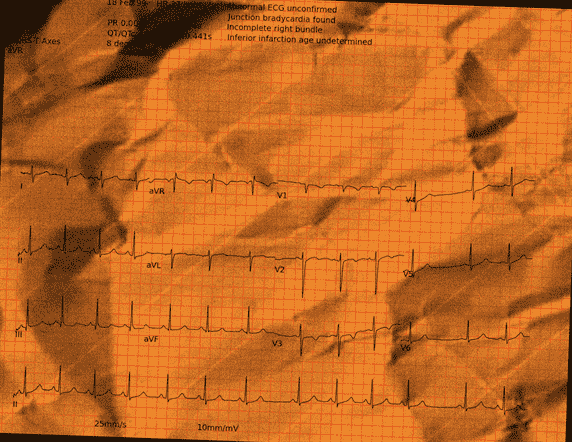 Normal ECG — PTB-XL