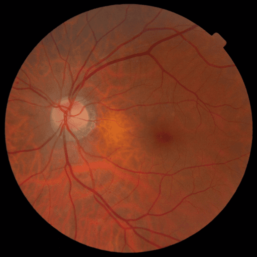 No Diabetic Retinopathy — MESSIDOR-2