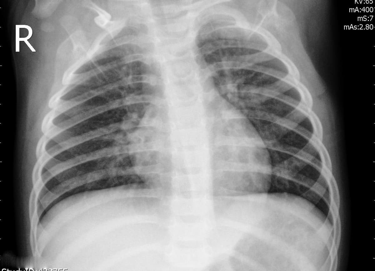 Pneumonia — NIH Chest X-ray14