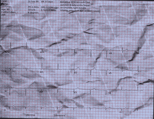 Normal ECG — PTB-XL