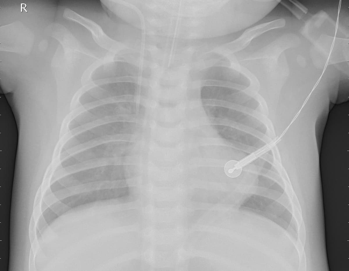 Pneumonia — NIH Chest X-ray14
