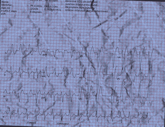 Normal ECG — PTB-XL