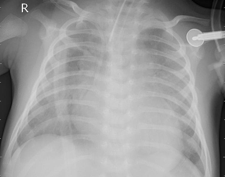 Pneumonia — NIH Chest X-ray14