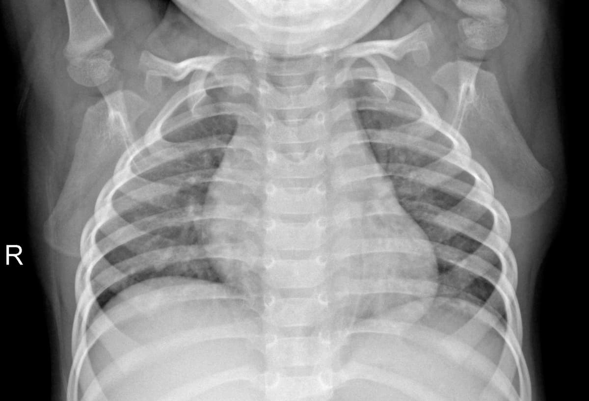 Radiografia Normal — NIH Chest X-ray14