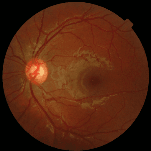 No Diabetic Retinopathy — MESSIDOR-2