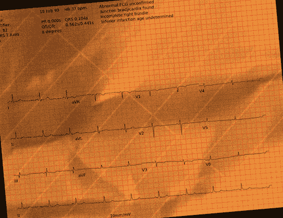 Normal ECG — PTB-XL