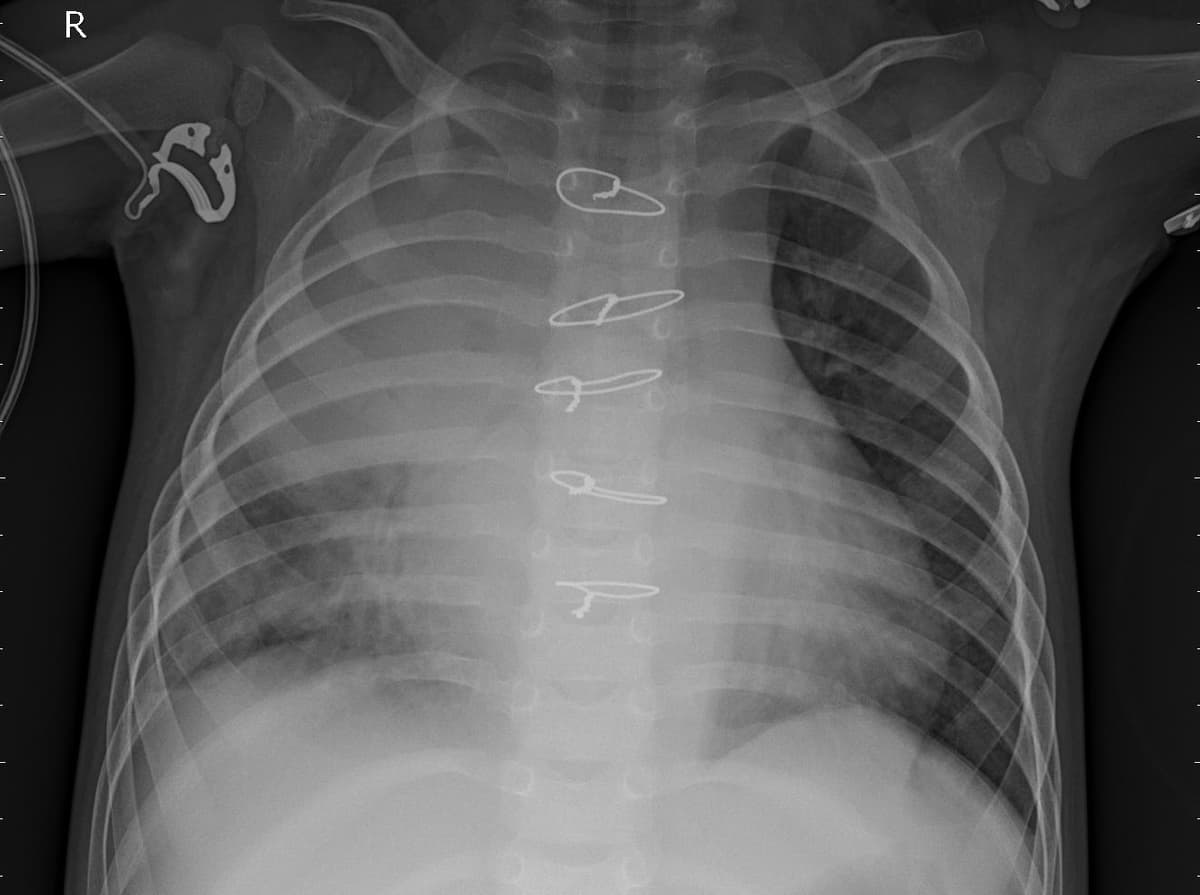 Pneumonia — NIH Chest X-ray14