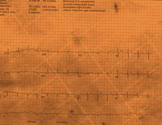 Normal ECG — PTB-XL