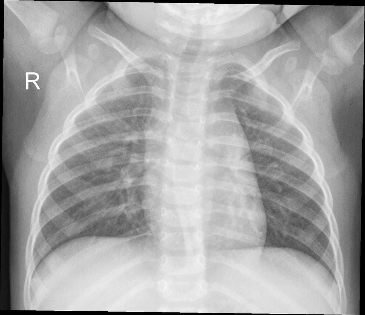 Radiografia Normal — NIH Chest X-ray14