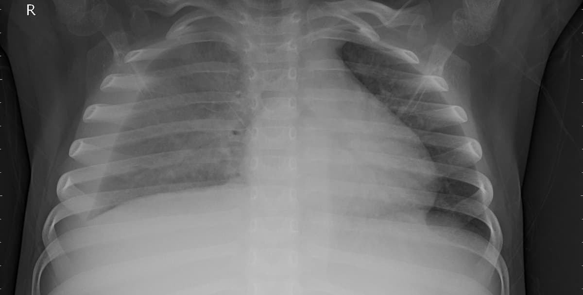 Pneumonia — NIH Chest X-ray14