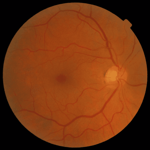 No Diabetic Retinopathy — MESSIDOR-2