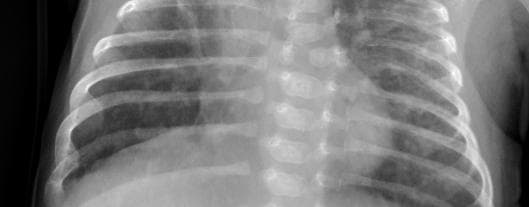 Pneumonia — NIH Chest X-ray14