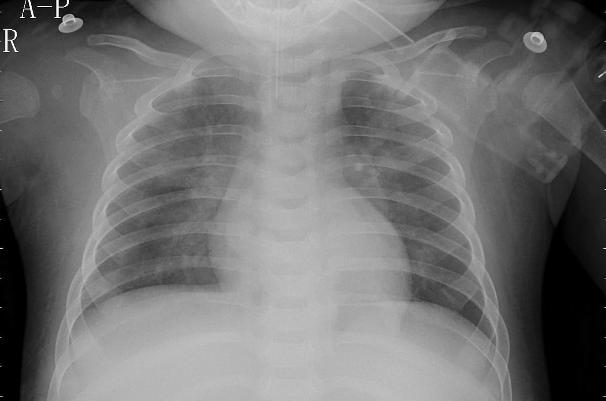 Pneumonia — NIH Chest X-ray14