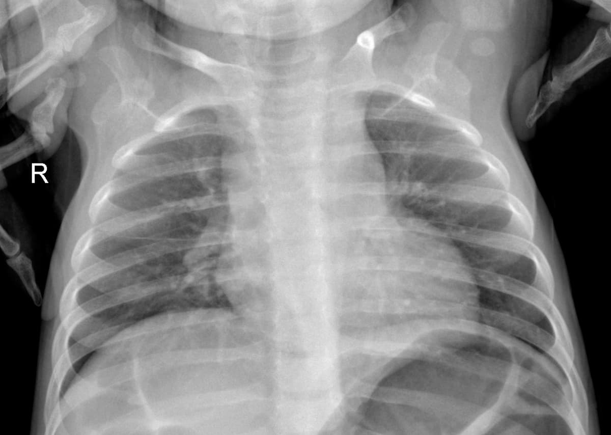 Radiografia Normal — NIH Chest X-ray14