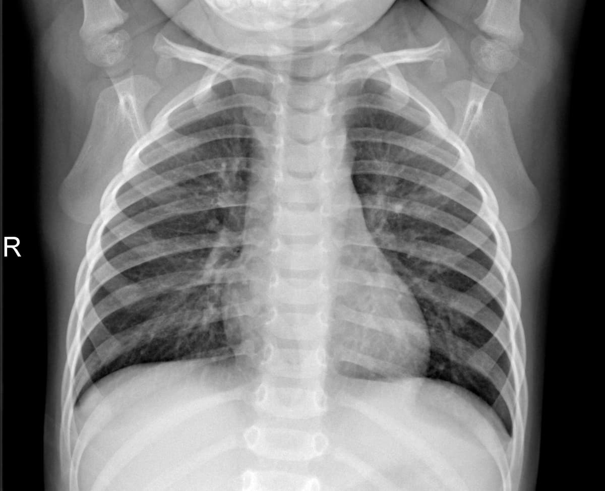 Radiografia Normal — NIH Chest X-ray14