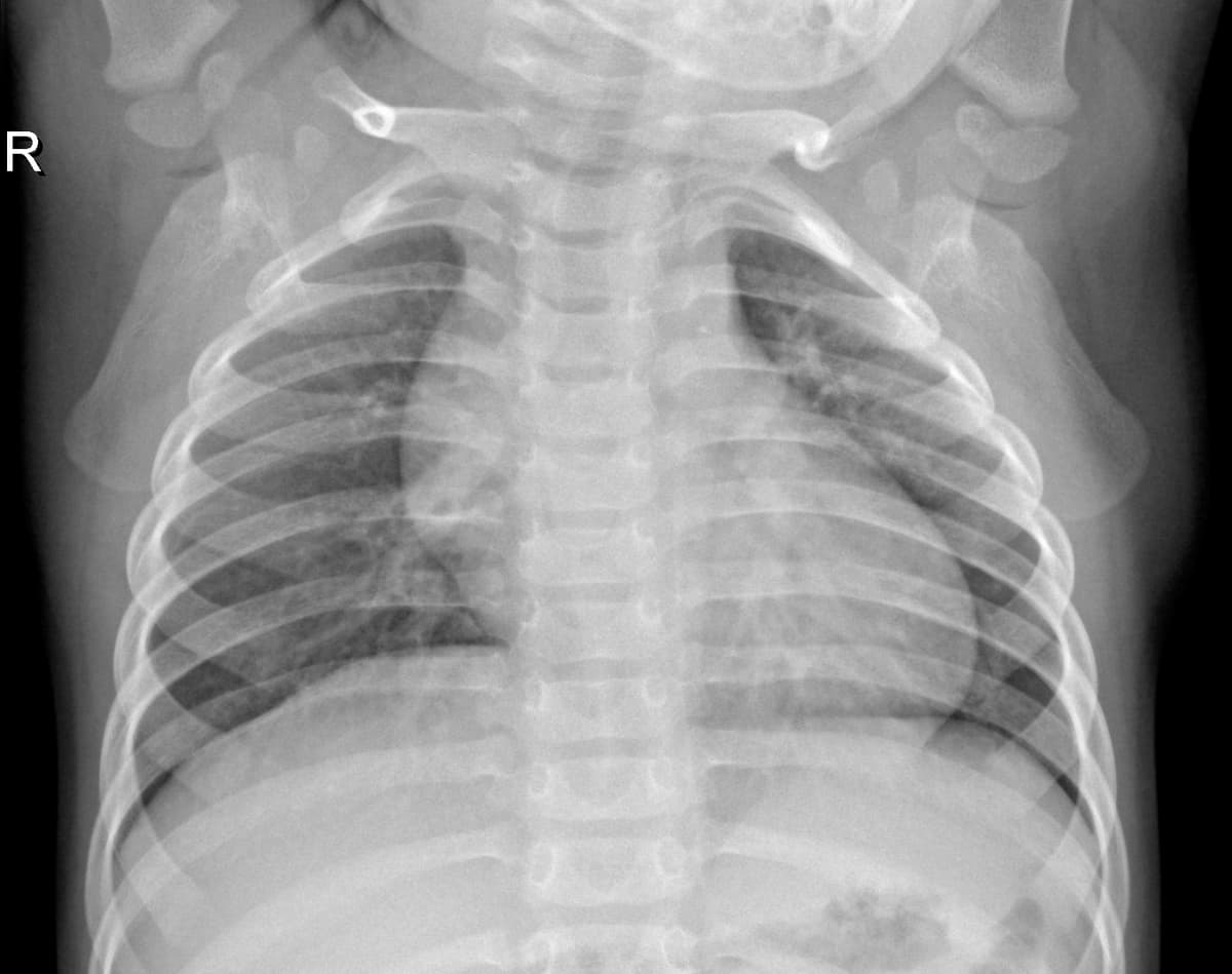 Radiografia Normal — NIH Chest X-ray14