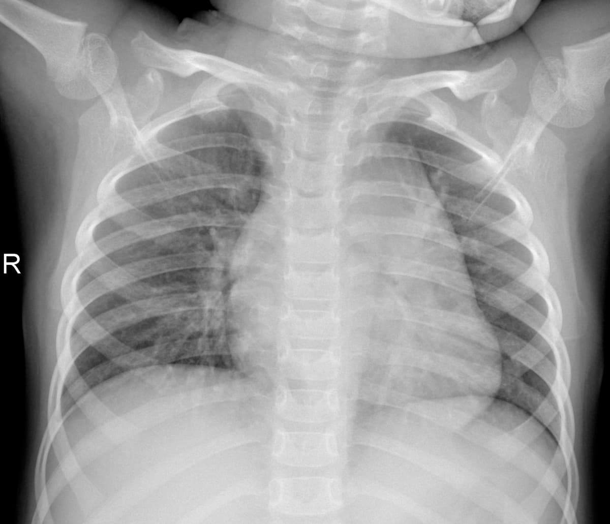 Radiografia Normal — NIH Chest X-ray14