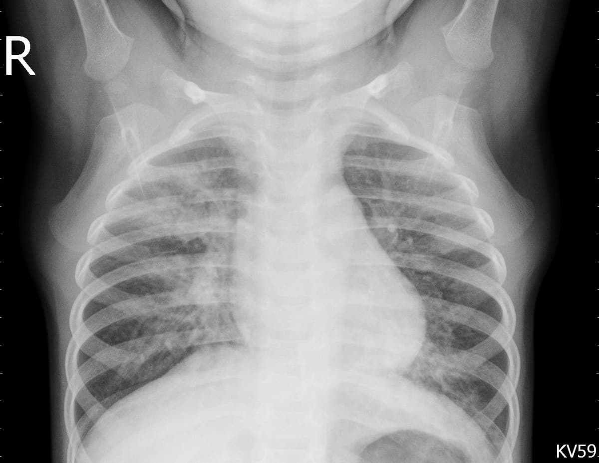 Pneumonia — NIH Chest X-ray14
