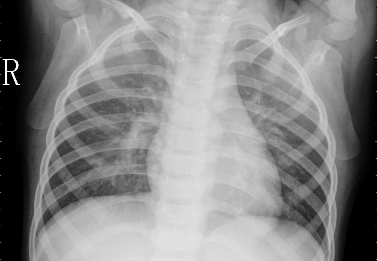 Pneumonia — NIH Chest X-ray14