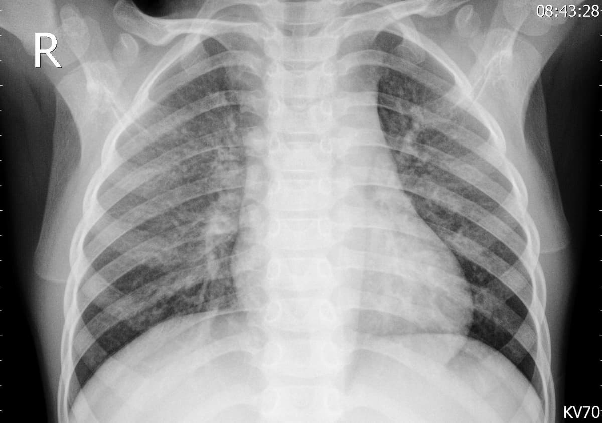 Pneumonia — NIH Chest X-ray14