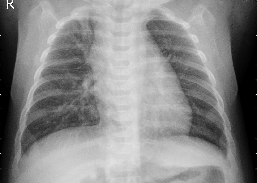 Pneumonia — NIH Chest X-ray14