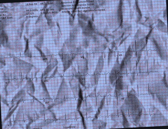 Normal ECG — PTB-XL