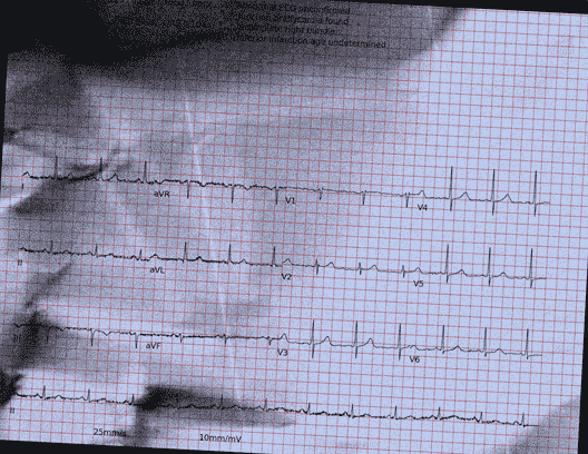 Normal ECG — PTB-XL