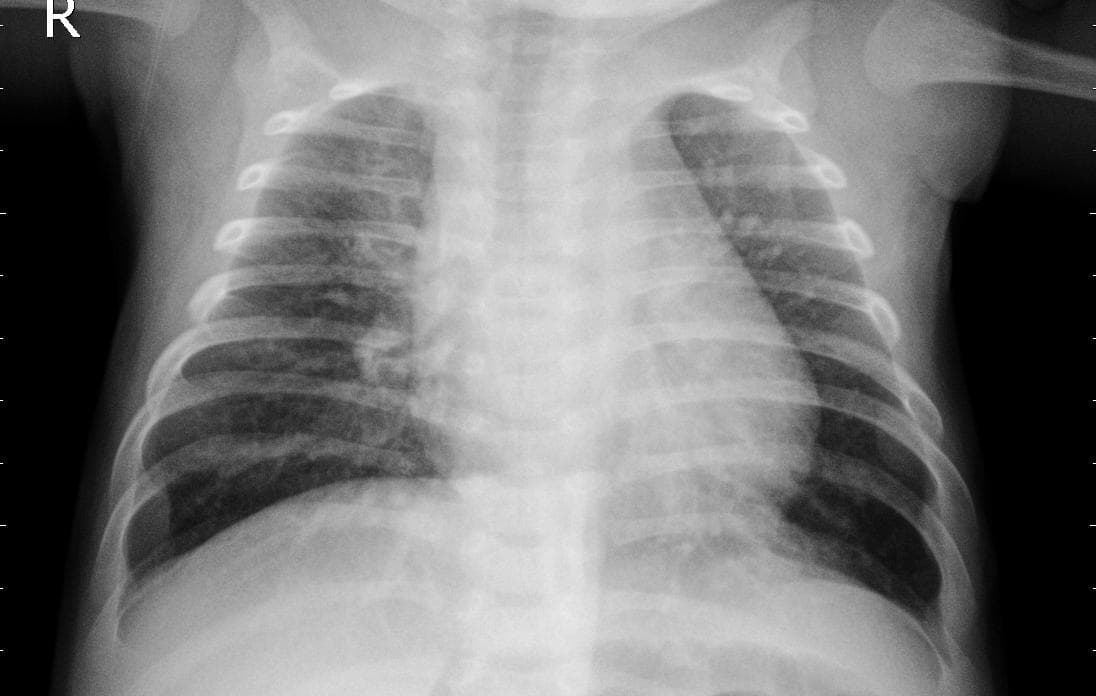 Pneumonia — NIH Chest X-ray14
