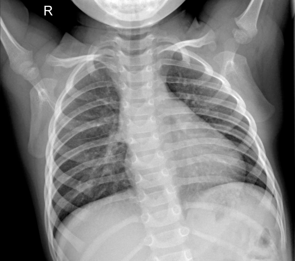 Radiografia Normal — NIH Chest X-ray14