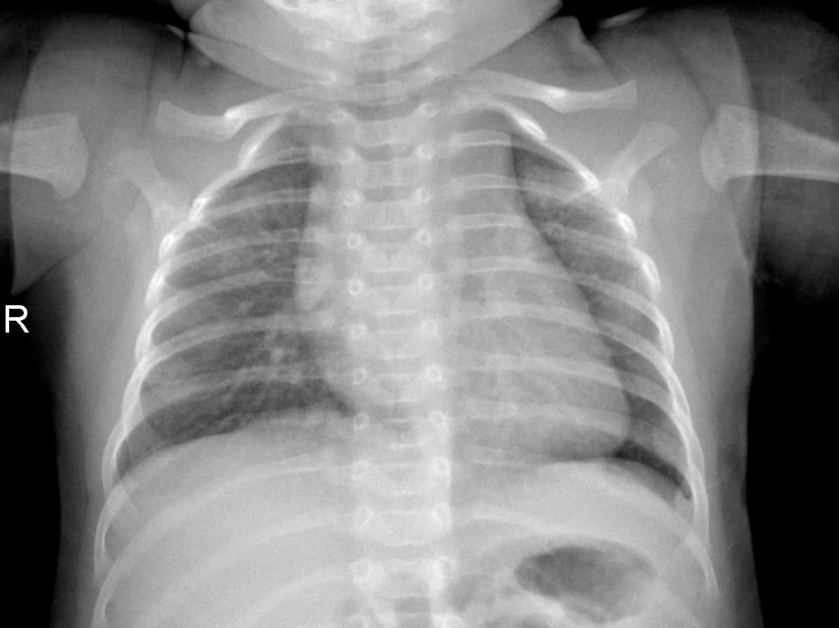 Radiografia Normal — NIH Chest X-ray14