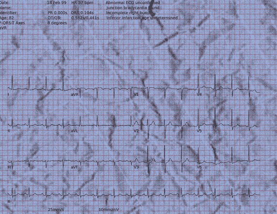 Normal ECG — PTB-XL
