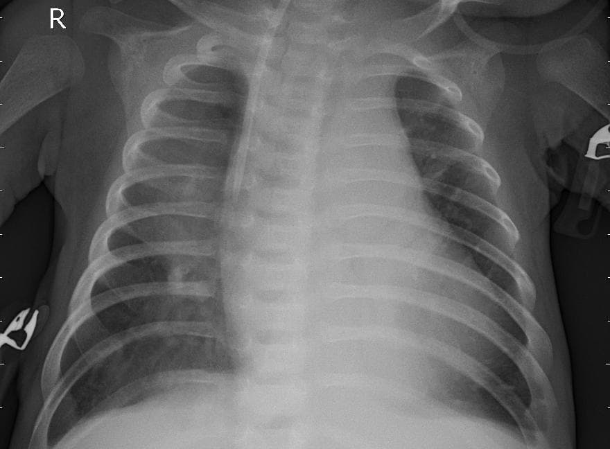 Pneumonia — NIH Chest X-ray14