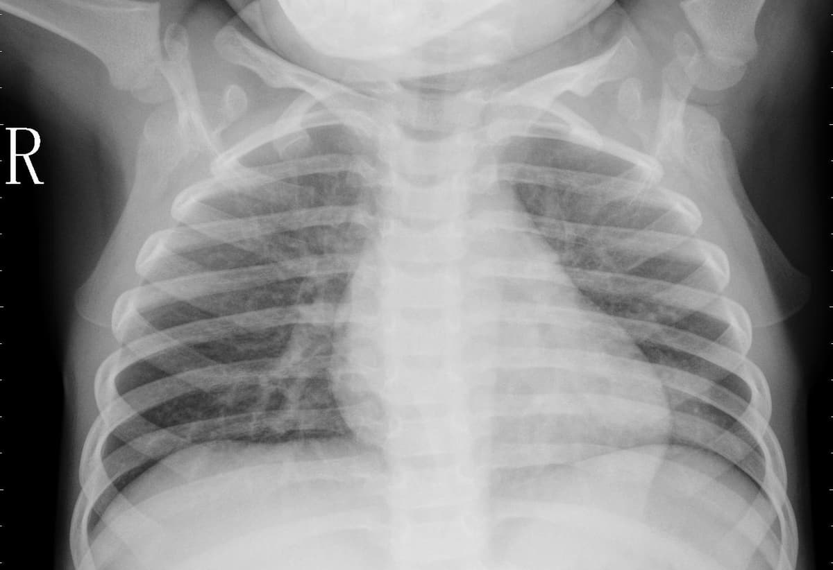 Pneumonia — NIH Chest X-ray14