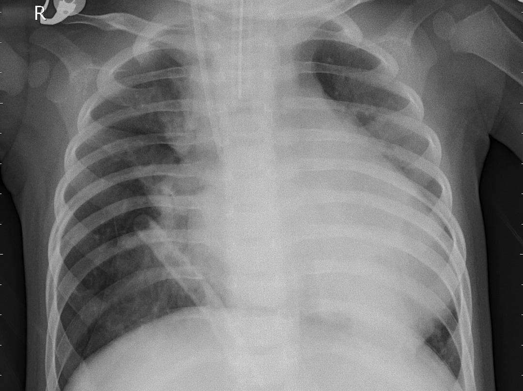Pneumonia — NIH Chest X-ray14