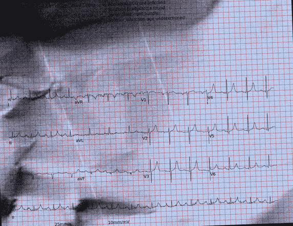Normal ECG — PTB-XL