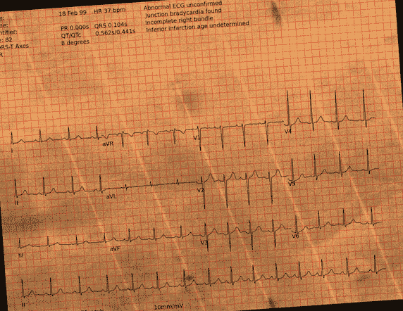 Normal ECG — PTB-XL