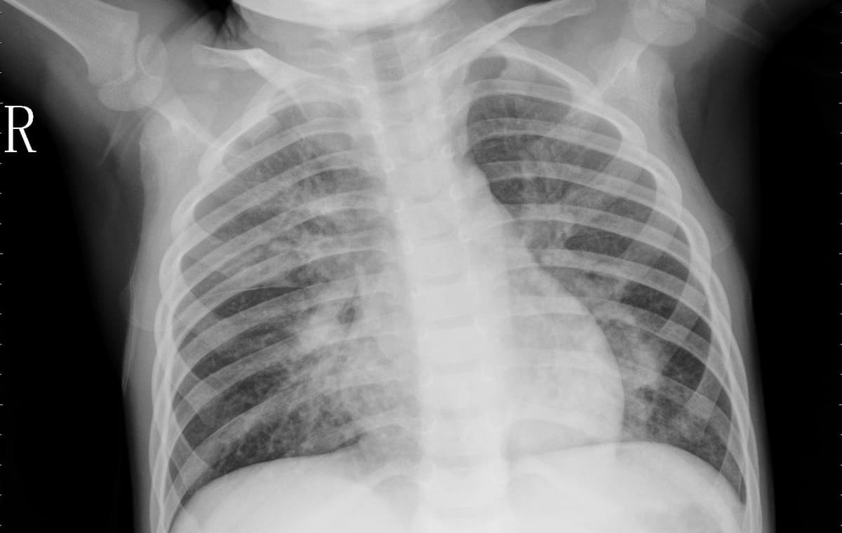 Pneumonia — NIH Chest X-ray14