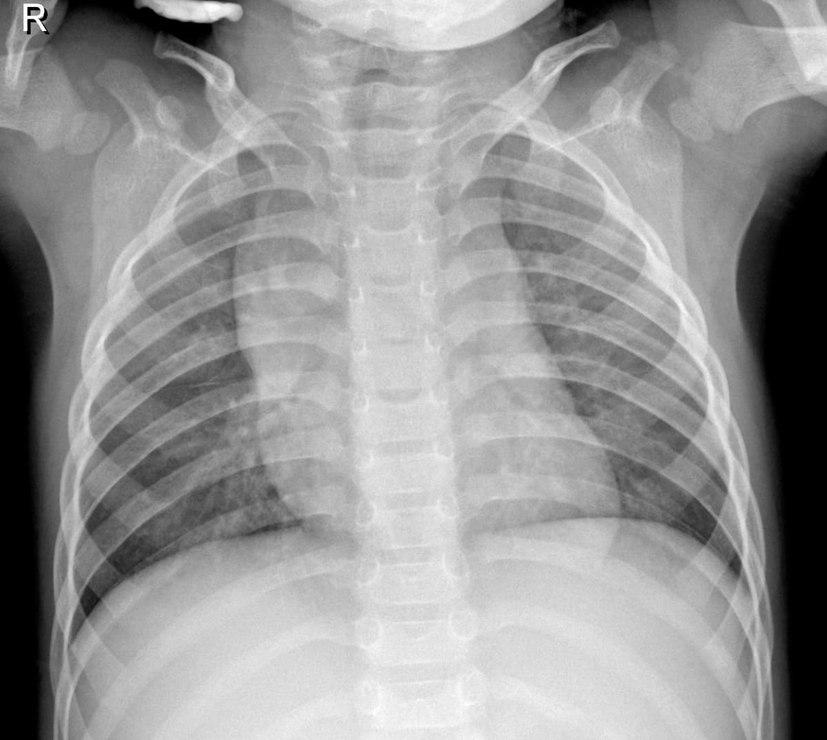 Radiografia Normal — NIH Chest X-ray14