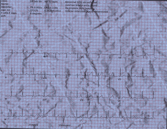 Normal ECG — PTB-XL