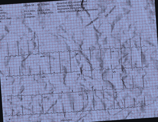 Normal ECG — PTB-XL