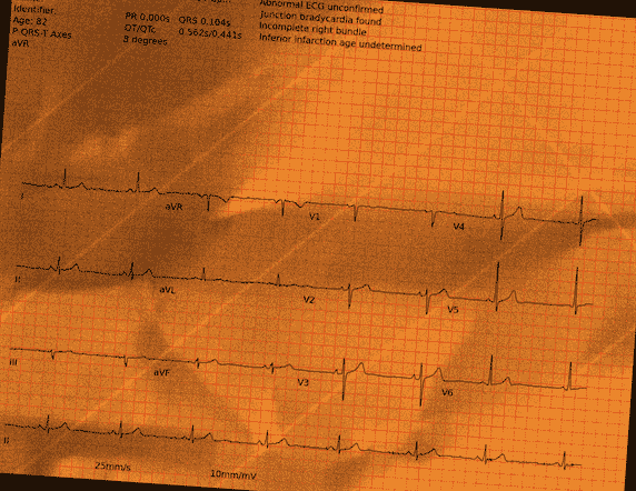 Normal ECG — PTB-XL