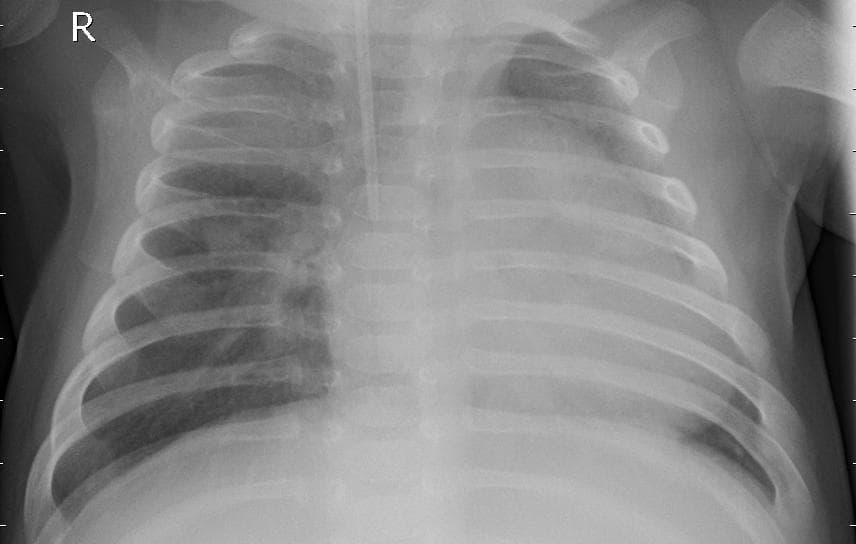 Pneumonia — NIH Chest X-ray14