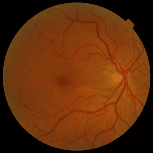 No Diabetic Retinopathy — MESSIDOR-2