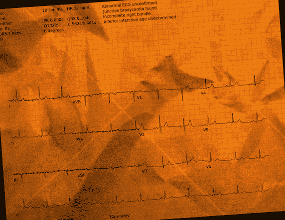 Normal ECG — PTB-XL
