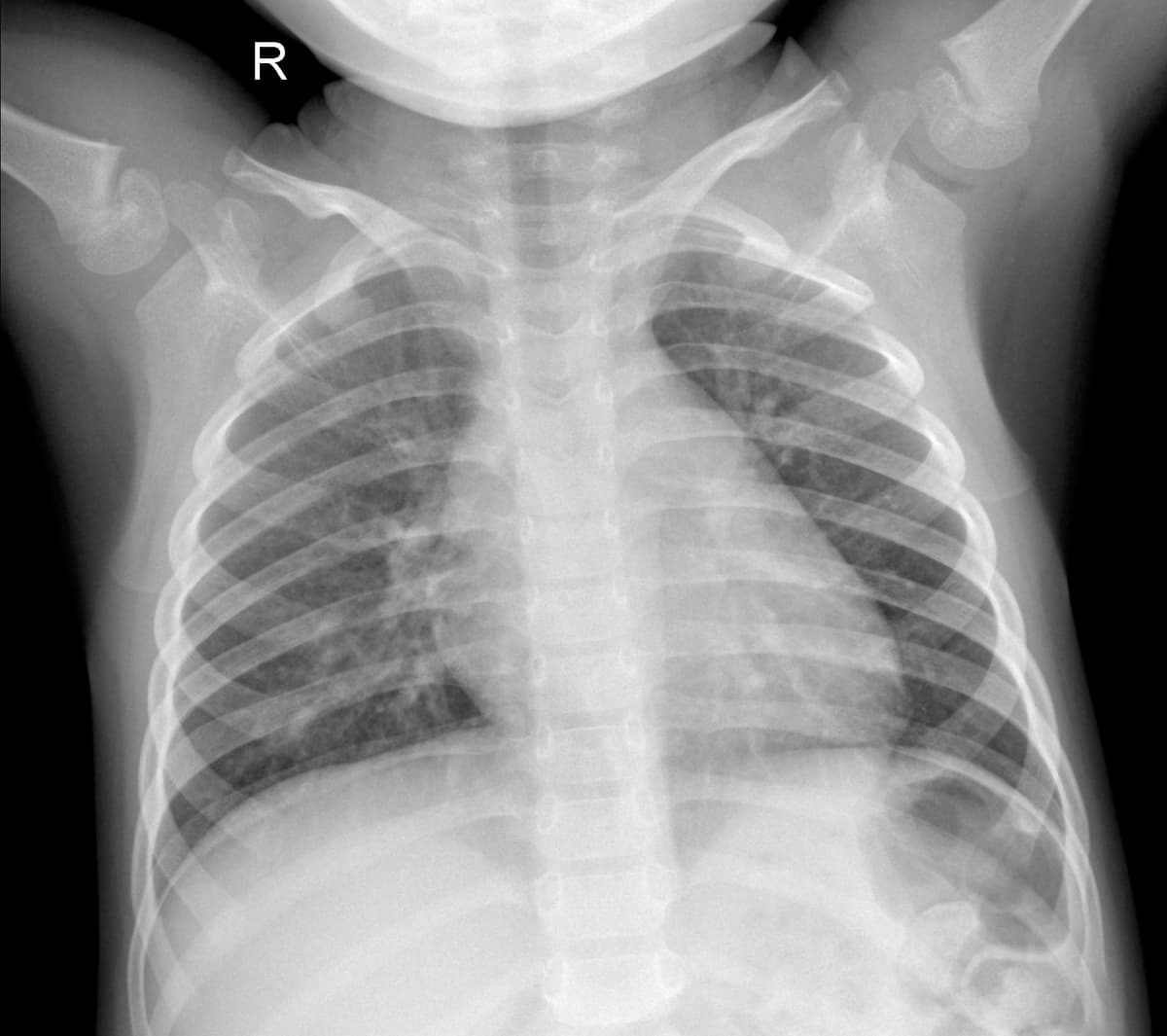 Radiografia Normal — NIH Chest X-ray14