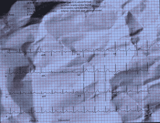 Normal ECG — PTB-XL