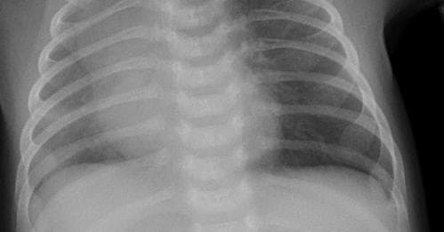 Pneumonia — NIH Chest X-ray14